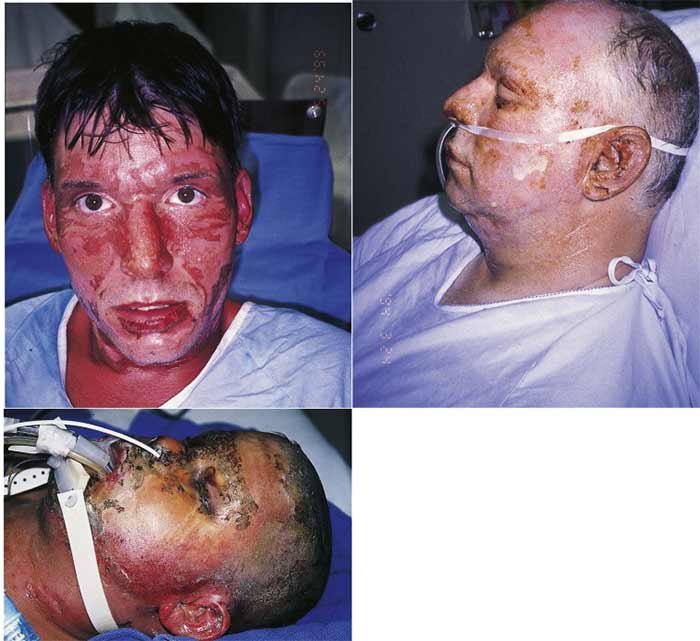 ترمیم چهره بعد از سوختگی 