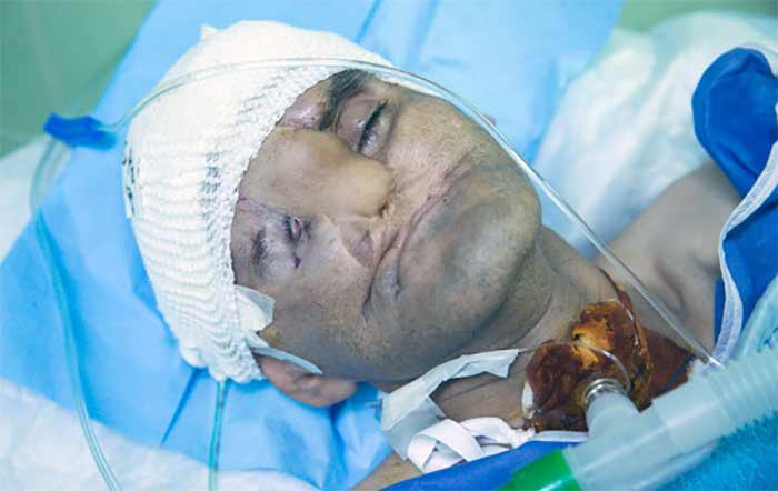 پیوند گسترده صورت موسی شیخ