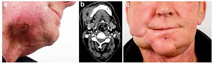 بازسازی فک و صورت