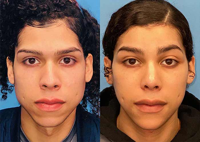 جراحی مؤنث‌سازی چهره