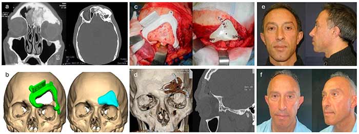 بازسازی هیبریدی صورت