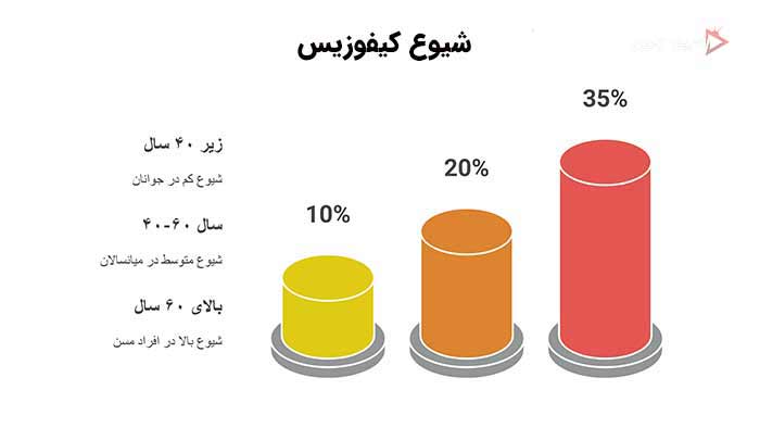 اینفوگرافی شیوع کیفوز