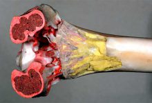 علائم و نشانه های بیماری کم کاری مغز استخوان و راه های درمان آن